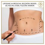 Liposukcja brzucha, boczków, bioder, ud, kolan, łydek, pleców, ramion