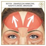 Botox zmarszczki mimiczne, nadpotliwość, bruksizm